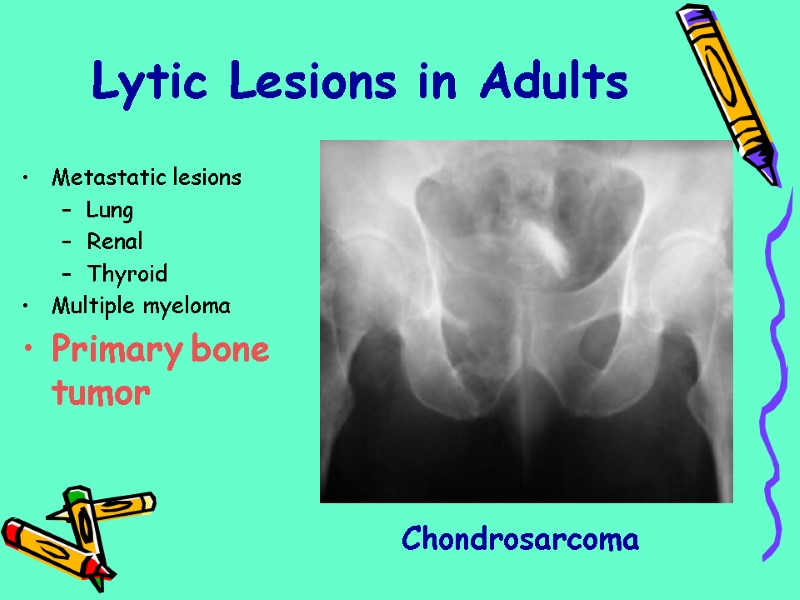 Metastatic lesions Lung Renal Thyroid Multiple myeloma Primary bone tumor Chondrosarcoma Lytic Lesions in